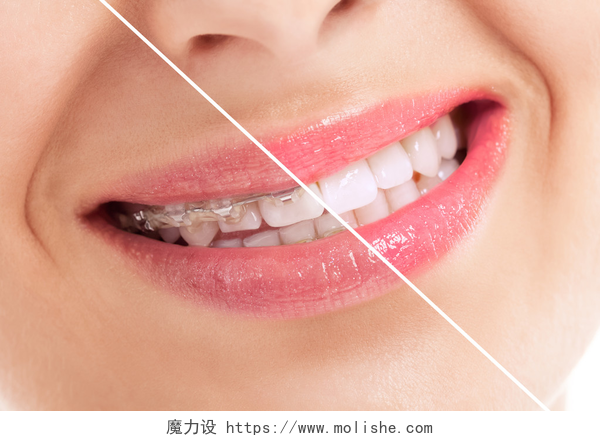 牙齿矫正前后对比图美丽健康微笑之前和之后大括号
